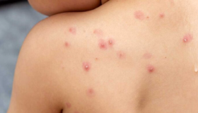 Esta es la segunda vez en dos años que se considera que esta enfermedad infecciosa puede convertirse en una amenaza sanitaria internacional.