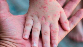 Organismos sanitarios piden más medidas de control tras el primer caso de mpox en Europa