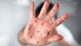 Los expertos de la salud han alertado sobre la viruela que podría llegar al país