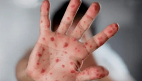 El centro de control de enfermedades de Alemania informa del primer caso de la nueva variante mpox 