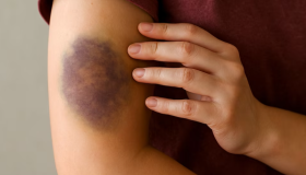 Hematomas recurrentes podrían indicar déficit de vitamina C 