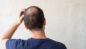 ¿Qué es la alopecia areata y cómo detectar sus primeras señales? 
