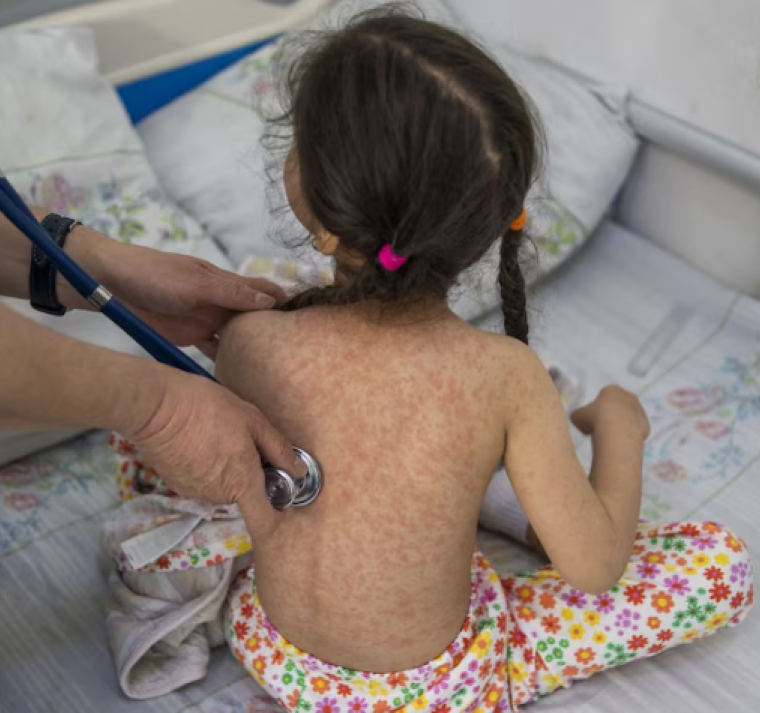Lo que debe saber sobre el sarampión: contagio, vacunación y riesgos de una enfermedad potencialmente mortal 